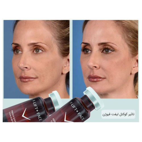 کوکتل لیفت دهنده فیوژن F-LIFT +FACE
