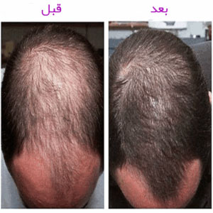 از محصولات ملایم و غیرتحریک‌کننده برای مراقبت از پوست استفاده کنید. همچنین از محصولاتی که ممکن است باعث تحریک پوست شوند، خودداری کنید.